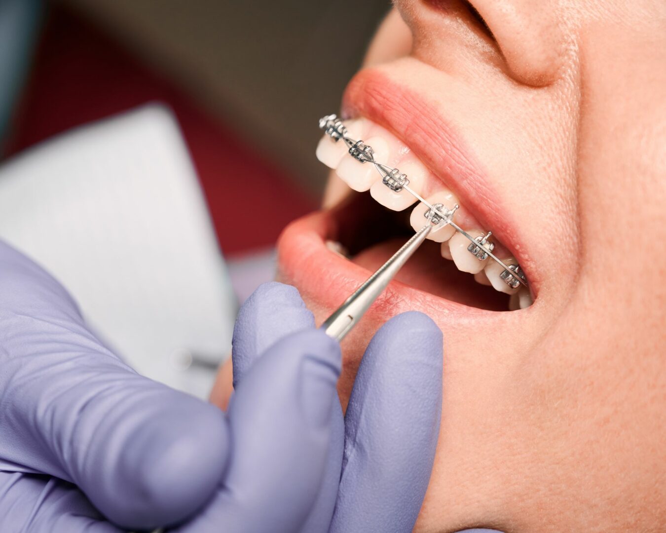 La pose d'un appareil dentaire est bénéfique pour vos dents