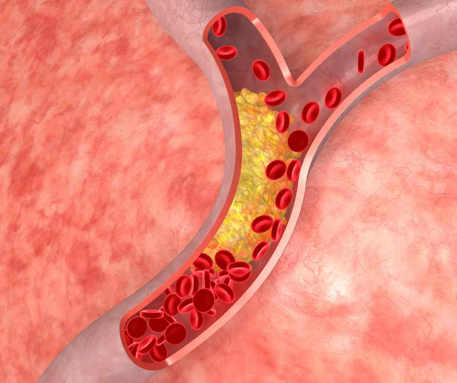 Les risques de l’excès de cholestérol : attention aux maladies cardiaques